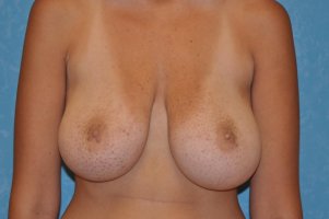 breast-reduction-88-view-1-detail.jpg