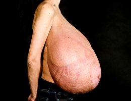 Gigantomastia and mastitis in pregnancy- A case report 01.jpg.