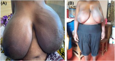 Photographs-of-the-patient-demonstrating-bilaterally-massive-breast-enlargement-in.png
